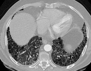 A 57-year-old woman with diagnosis of idiopathic pulmonary fibrosis has increasing shortness of breath and chest pain.