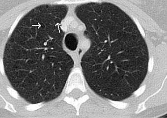 A 33-year-old man with a smoking history presented with a dry cough and restrictive ventilatory defect on pulmonary function testing.