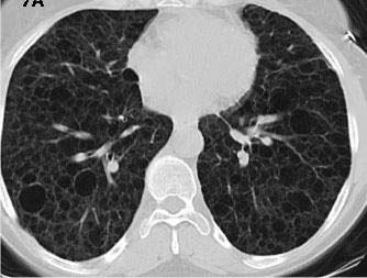 A 51-year-old woman with TSC complained of chronic dry cough.