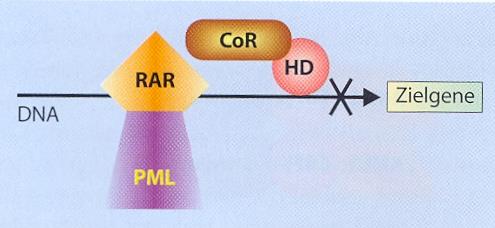 ΟΜΛ M3 με κυτταρογενετικούς δείκτες καλής πρόγνωσης (t 15;17) συγχώνευση του γονιδίου του υποδοχέα α του ρετινοϊκού οξέος (RAR-α) στο χρωμόσωμα 17 με το γονίδιο PML στο χρωμόσωμα 15.