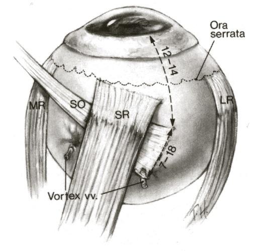 2. Ορθοί - λοξοί μύες Εικ. 7.3 Κατάφυση άνω λοξού μυός. ΜR: έσω ορθός, LR: έξω ορθός, SR: άνω ορθός, SO: άνω λοξός (από R.G. Michels et al., Retinal detachment, Mosby, 1990, p 4). Εικ. 7.4 Το πάχος του σκληρού.