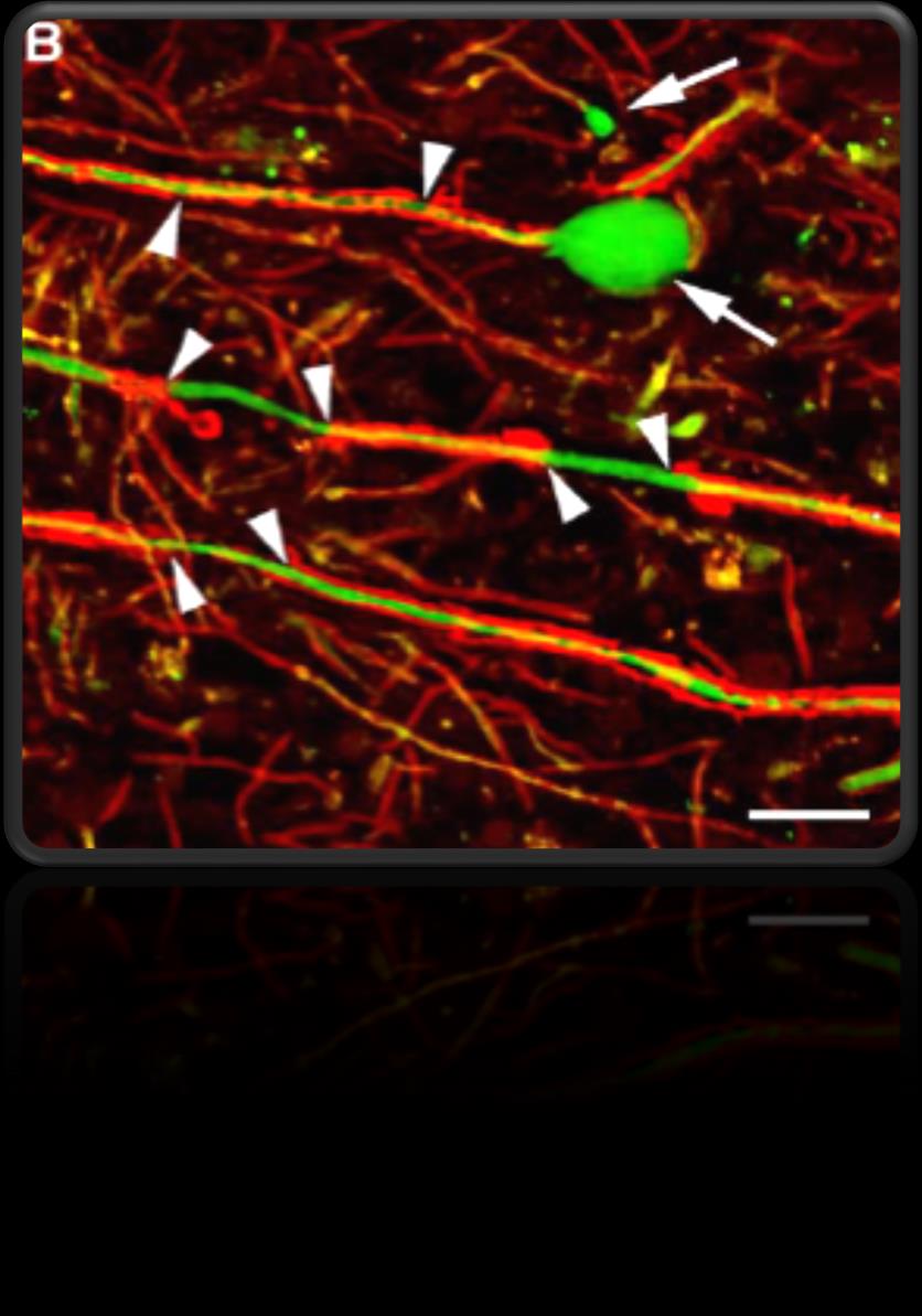 It has been shown that active inflammation results in both demyelination and axonal transection Arrowheads = areas of active demyelination; Arrow = terminal axon ovoid; Human brain; Red =