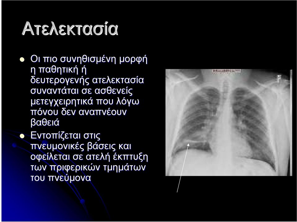 πόνου δεν αναπνέουν βαθειά Εντοπίζεται στις πνευμονικές βάσεις