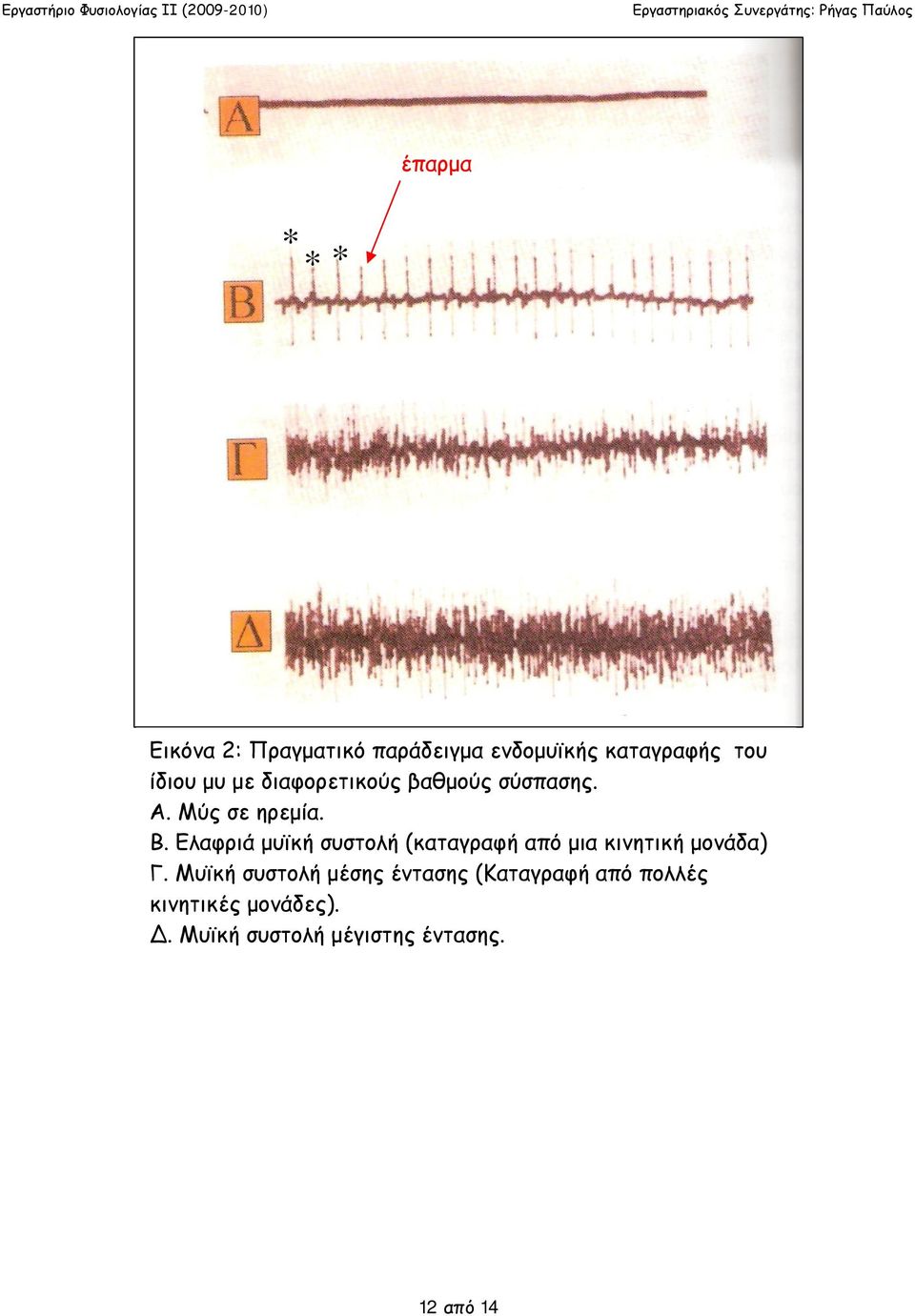Ελαφριά μυϊκή συστολή (καταγραφή από μια κινητική μονάδα) Γ.