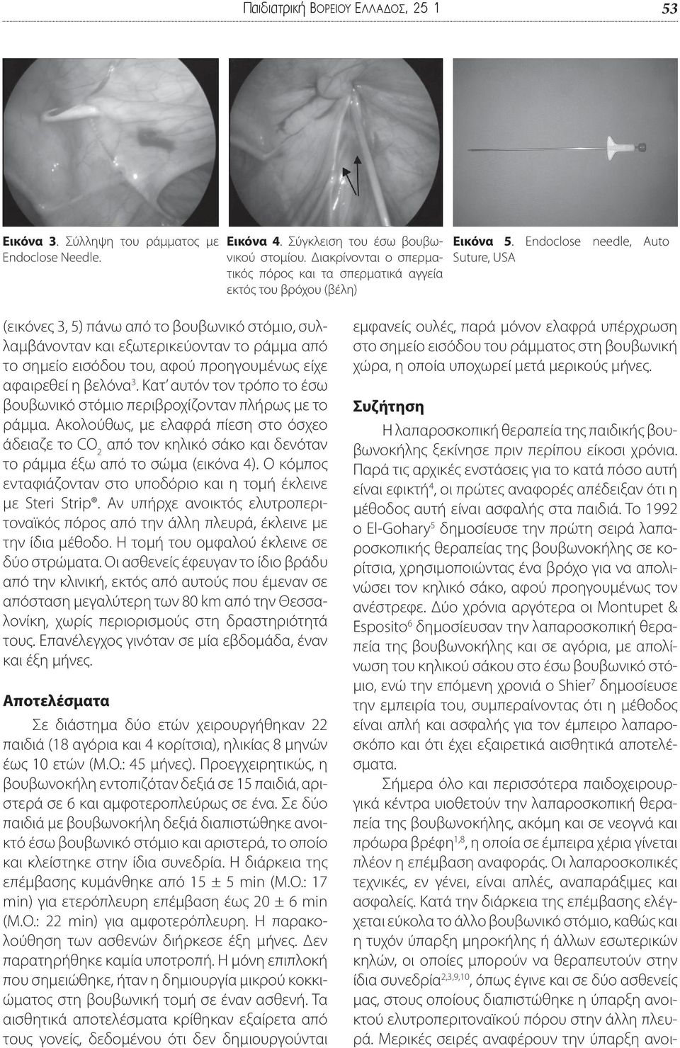 Endoclose needle, Auto Suture, USA (εικόνες 3, 5) πάνω από το βουβωνικό στόμιο, συλλαμβάνονταν και εξωτερικεύονταν το ράμμα από το σημείο εισόδου του, αφού προηγουμένως είχε αφαιρεθεί η βελόνα 3.