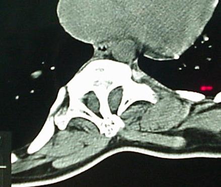Tethered Cord Syndrome & Occult
