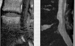 δισκίτις MRI: T1: απώλεια λεπτομέρειας Πηκτοειδής