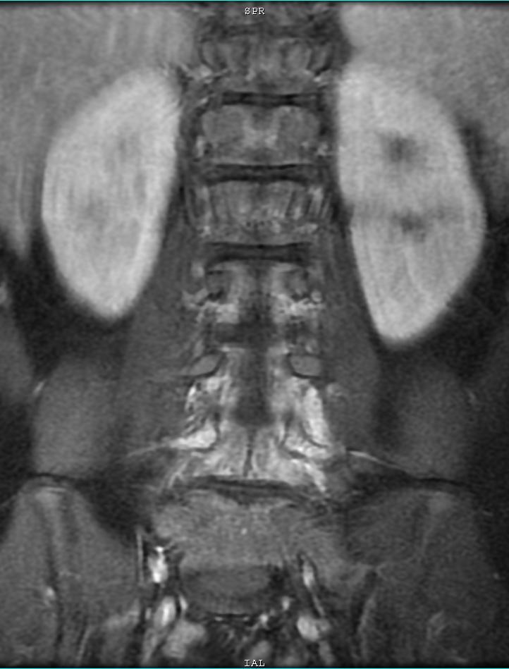 MRI
