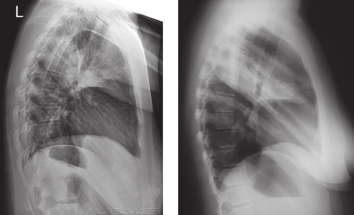 Βασικές Προβολές Αναπνευστικού Σύστηματος 57 Εικόνα 1.17. Πλάγια ακτινογραφία θώρακα με τον ασθενή να παρουσιάζει στροφή (αριστερά) και με τον ασθενή σωστά τοποθετημένο (δεξιά) ( 1994 Κουμαριανός Δ.). 46.
