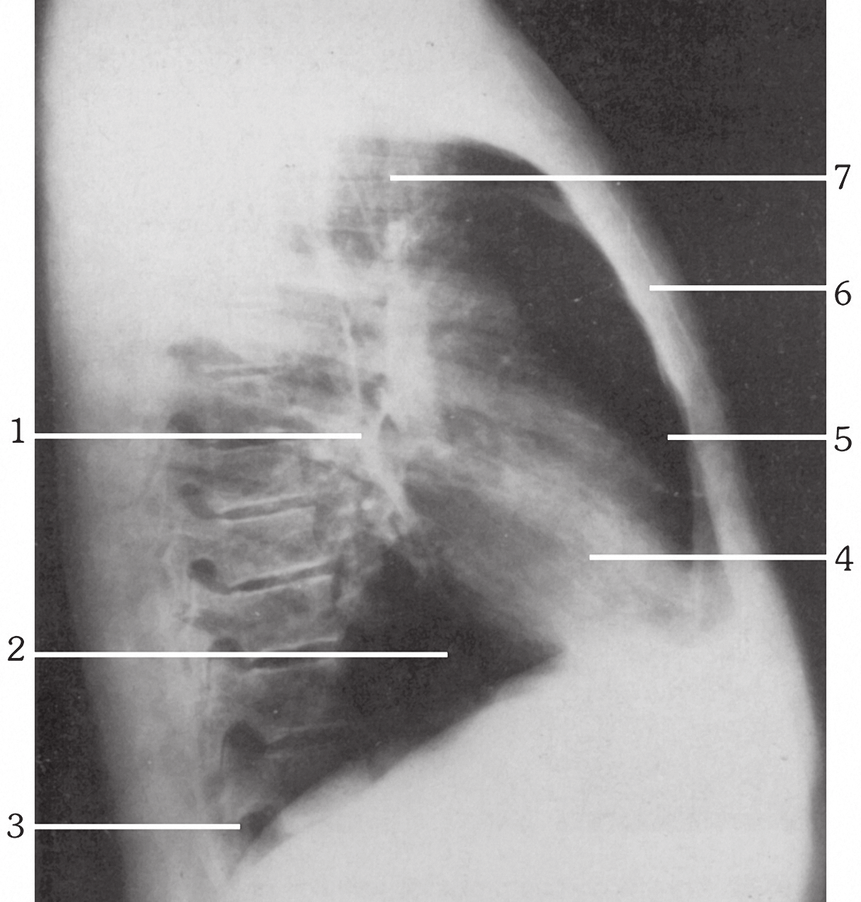 74 Βασικές Προβολές Αναπνευστικού Σύστηματος Οι ερωτήσεις 70-74 αναφέρονται στην ακτινογραφική ανατομία της ο-π ακτινογραφίας θώρακα της διπλανής εικόνας. Εικόνα 1.23. ( 1999 Κουμαριανός Δ.). 70. Ποιος αριθμός αντιστοιχεί στον οπισθοστερνικό χώρο; 71.