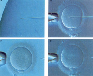 βιοψία TESE. Μετά την κατάλληλη επεξεργασία του σπέρματος, επιλέγεται ένα μόνο σπερματοζωάριο, το άριστο μορφολογικά και κινητικά, και τοποθετείται μέσα στο κυτταρόπλασμα του ωαρίου.