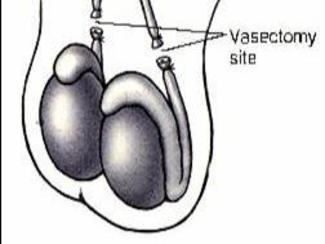 al. 2004 διατομή σπερματικού πόρου (Vasectomy) 3% των ζευγαριών Πιο συνηθισμένο σε: Ανεπτυγμένες κοινωνίες (10%) Άνδρες υψηλού