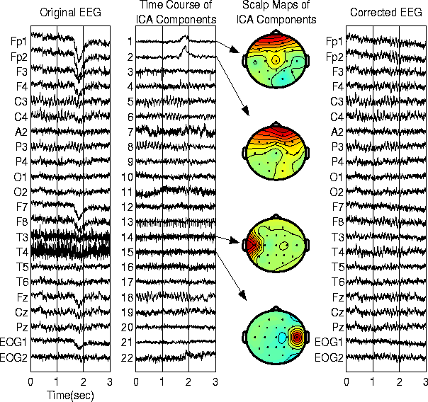 ΗΕΓ θόρυβος από άλλα σήματα Συχνά υπάρχουν παρεμβολές: - Σήματα από μυϊκές κινήσεις ματιών (eye
