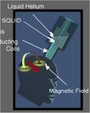 ΜαγνητοΕγκεφαλοΓραφημα (ΜΕΓ) Μαγν. πεδίο έξω από το κρανίο λόγω ηλεκτρ. δραστηρ. νευρώνων (ροή ηλ. φορτίων, α κύμα: 10-14 Τ, γη: ~10-5 ). Υπερευαίσθητοι ανιχνευτές μαγνητόμετρα (SQUID).