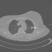 CT guided thoracic biopsy CT guided thoracic biopsy is usually performed for the diagnosis of suspicious lung, pleural or mediastinal lesions.