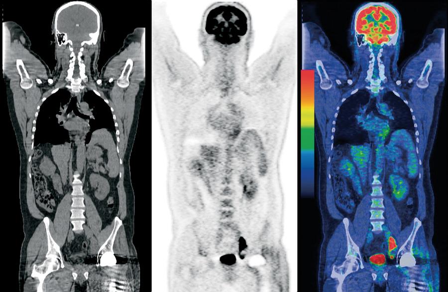 PET-CT PET-CT είναι ένας συνδυασμός ανατομικών πληροφοριών που παρέχονται από ΥΤ και το μεταβολικών πληροφοριών που παρέχονται με τομογραφία εκπομπής