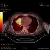 Χρησιμότητα PET-CT Χρησιμότητα PET-CT στη σταδιοποίηση του καρκίνου του πνεύμονα Η ΡΕΤ-CT έχει αποβεί εξαιρετικά χρήσιμη στη μελέτη του μη μικροκυττάρου καρκίνου του πνεύμονα με τρεις μείζονες