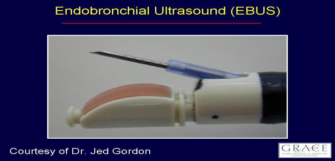 Endoscopic Ultrasound (Ενδοβρογχικός) Αυτή η διαδικασία ονομάζεται επίσης ενδοϋπερηχοτομογραφία.