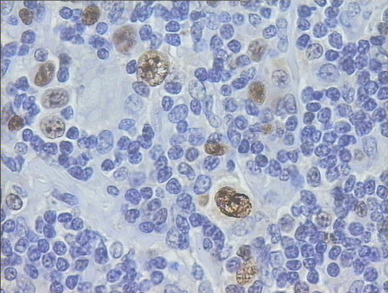 Νεοπλασματικό κύτταρο: Διπύρηνο Reed-Sternberg ή μονοπύρηνο Hodgkin Β-κυτταρική προέλευση Πολύμορφος αντιδραστικός κυτταρικός πληθυσμός,
