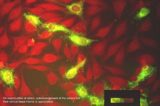 Rapid diagnosis of Respiratory Syncytial Virus