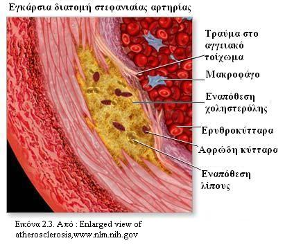 Εναρκτήριο γεγονός αποτελεί η βλάβη του αγγειακού ενδοθηλίου.