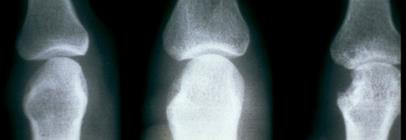 Severity Ζ ΠΟΡΔΗΑ ΣΖ ΡΔΤΜΑΣΟΔΗΓΟΤ ΑΡΘΡΗΣΗΓΑ early RA intermediate late RA Disease activity Radiographic
