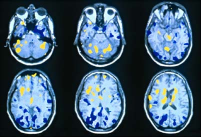 Η θεραπεία με VNS ρυθμίζει την αιματική ροή σε σημαντικές εγκεφαλικές δομές (μελέτη με PET-scan) Σημαντικές αμφοτερόπλευρες μεταβολές της αιματικής ροής παρατηρήθηκαν κατά τη διάρκεια της θεραπείας