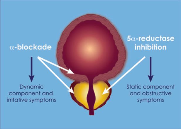 Medical Therapy Of Prostatic Symptoms (MTOPS) Trial FU Treatment arms Pts δips S δqmax [ml/s] δpv Placebo 737-4. +1.