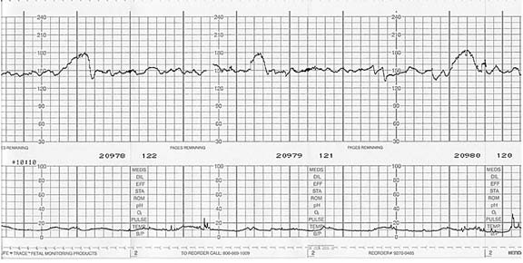 Reliability of the Biophysical Profile-Overview Reactive nonstress test. The top graph plots the fetal heart rate over time.