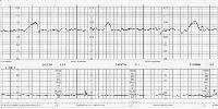 Reliability of the Biophysical Profile-Overview The BPP allows 2 points for each parameter that is present, yielding a maximum score of 10; however, if all of the ultrasonographic variable findings