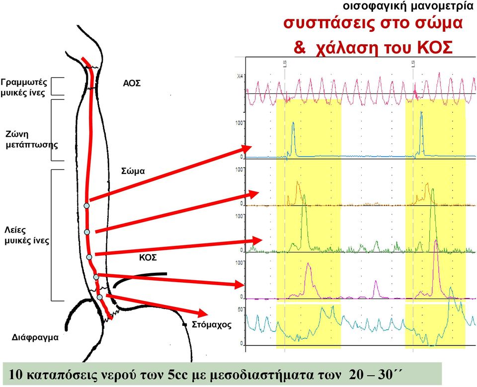 Σώκα Λείεο κπηθέο ίλεο ΚΟΣ Δηάθξαγκα