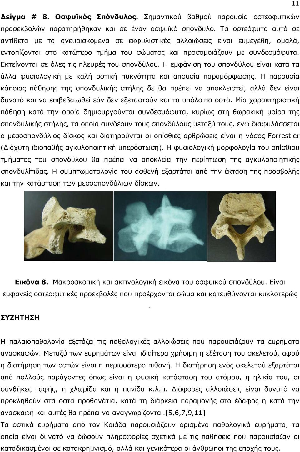 Εκτείνονται σε όλες τις πλευρές του σπονδύλου. Η εμφάνιση του σπονδύλου είναι κατά τα άλλα φυσιολογική με καλή οστική πυκνότητα και απουσία παραμόρφωσης.
