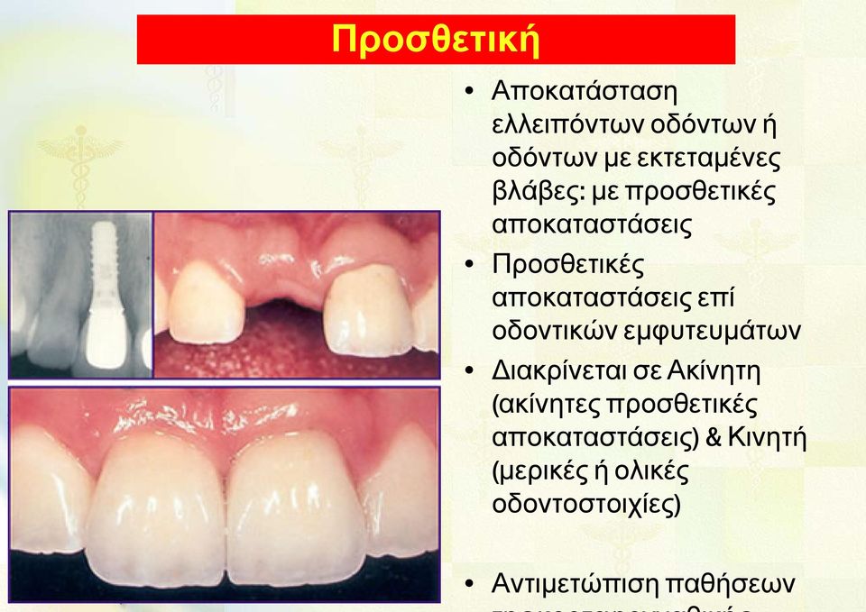 οδοντικών εμφυτευμάτων Διακρίνεται σε Ακίνητη (ακίνητες προσθετικές