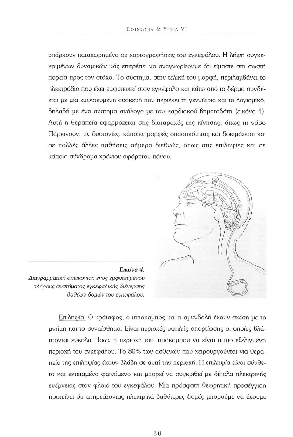 δηλαδή με ένα σύστημα ανάλογο με του καρδιακού βηματοδότη (εικόνα 4).