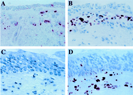 Φαινότυποι σοβαρού άσθματος Eosinophil +ve severe asthma Eos Neutrophils