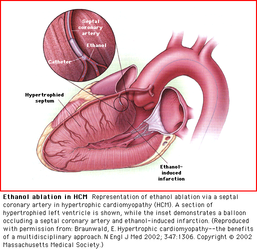 ΥΠΕΡΤΡΟΦΙΚΗ ΚΑΡΔΙΟΜΥΟΠΑΘΕΙΑ NSRT (alcohol septal ablation) Controlled myocardial infarction of the basal