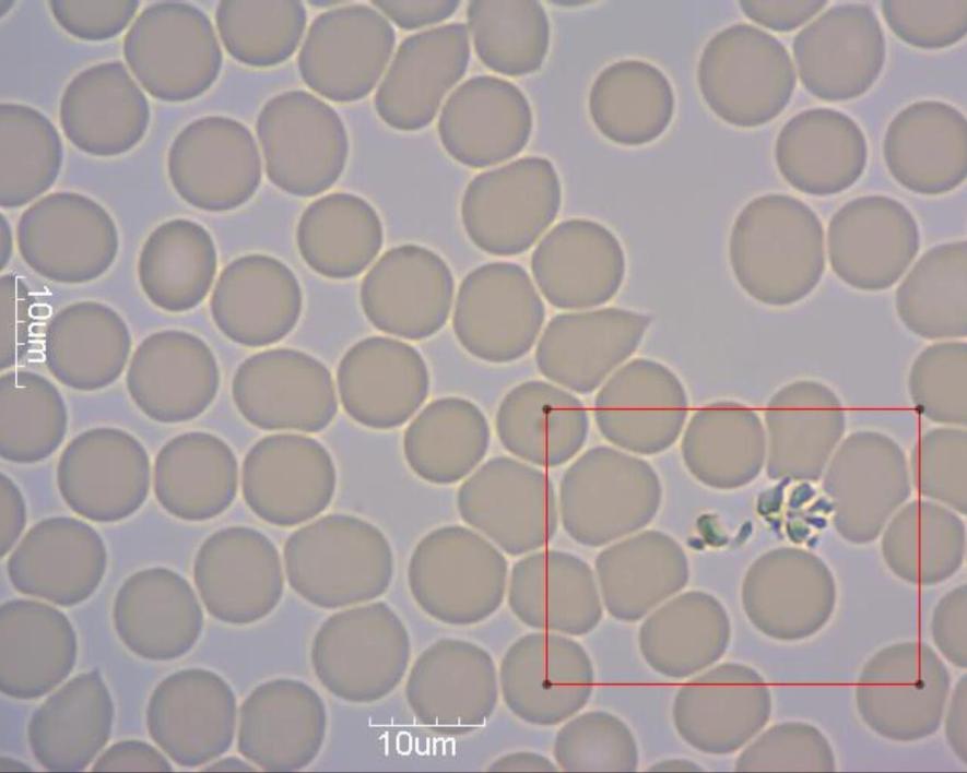 Obr 5: Biela kvasinka (pravdepodobne Candida Albicans) a vlákna fibrinogénu (dôsledok intoxikovanej pečene) - intravitálna mikroskopia kapilárnej krvi. Obr.