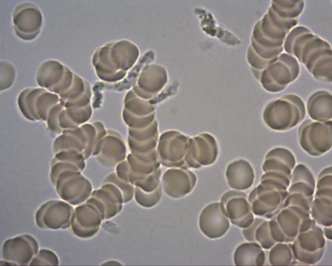 Obr. 10: Aktivované vajíčka črevných parazitov intravitálna mikroskopia kapilárnej krvi. Obr.11: Mŕtve larvy črevných parazitov intravitálna mikroskopia kapilárnej krvi.