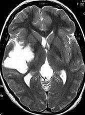 Diffusion Imaging