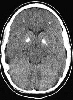 Φλεγμονές Cytomegalovirus