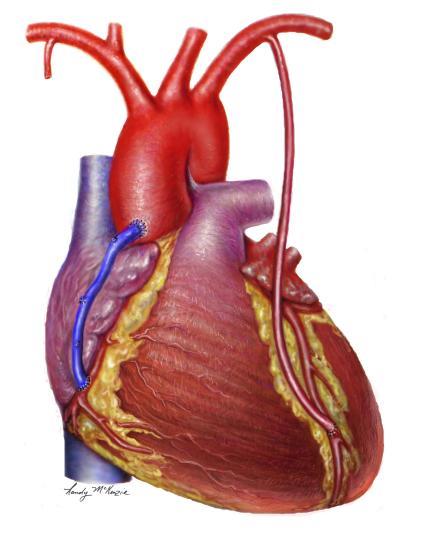 Αξονική στεφανιογραφία σε ασθενείς μετά από αορτοστεφανιαία παράκαμψη Φώτιος