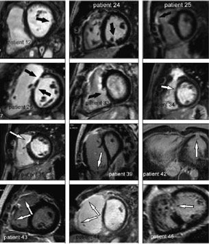 Delayed Enhancement imaging in