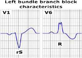 Διαταραχές ενδοκοιλιακής αγωγής QRS>120 RBBB Όχι σύνηθες Πιο «αθώο» Πιθανότητα ASD LBBB Πολύ σπάνιο