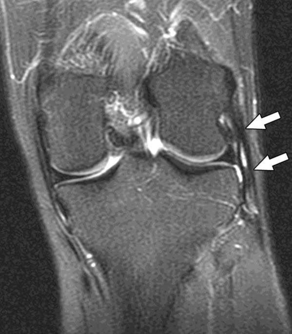 Normal fibular collateral ligament in 21-year-old woman.