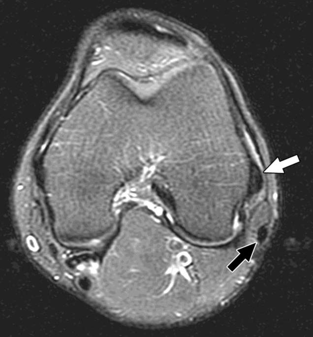 Normal fibular collateral ligament in 21-year-old woman.