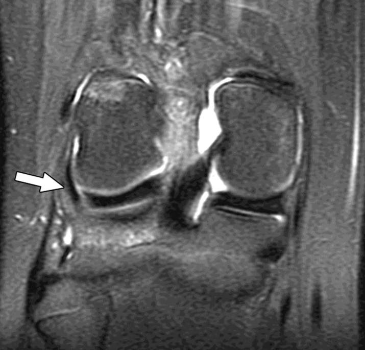Normal popliteus tendon and muscle in 15-year-old girl.
