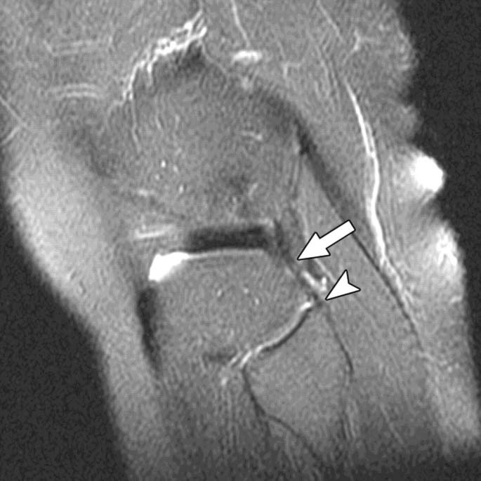 Intact popliteofibular ligament in 60-year-old woman.