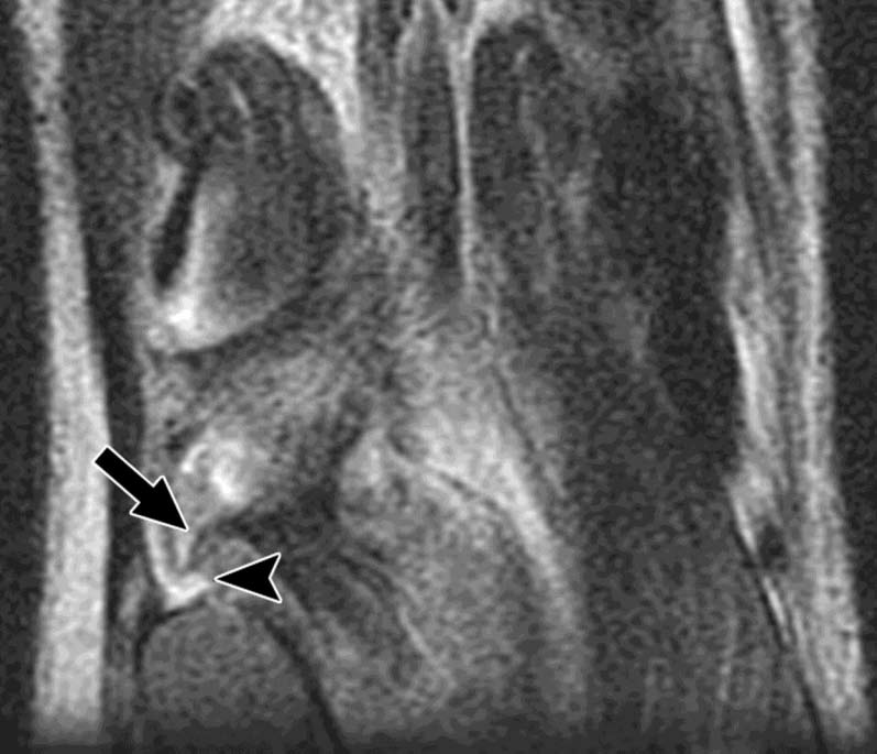 Torn popliteofibular ligament in 27-year-old man.