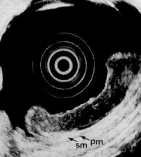 MALT-óm