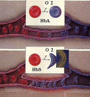 Αιμολυτικές αναιμίες Δρεπανοκυτταρική αναιμία Glu Val 1:500 στους μαύρους H-W: φορείς ~8% HbA Ενδοκυτταρικός σχηματισμός ινιδίων της HbS (ηλεκτρονικό μικροσκόπιο) οξυγόνο HbS